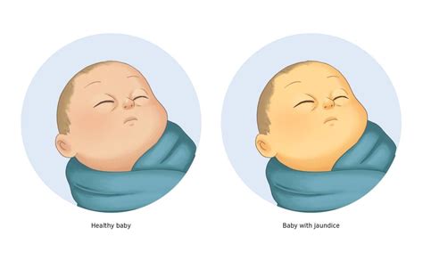 Neonatal Jaundice