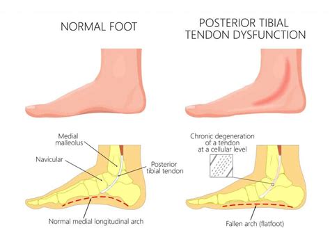 Posterior Tibial Tendonitis | Diagnosis, Symptoms and Treatments