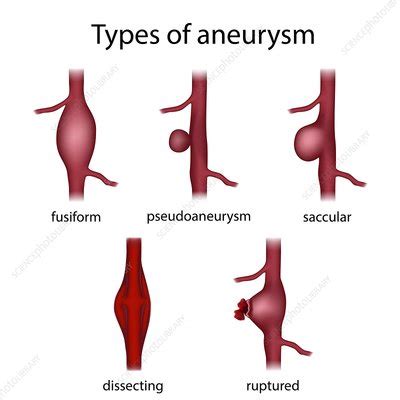 Aneurysm: Types, Classification & Morphology latest 2020?? ~ Medical documentry