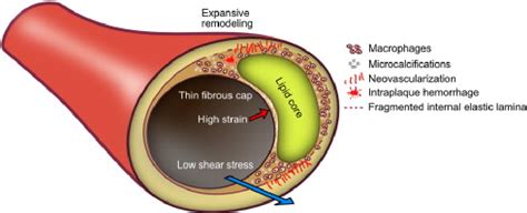 Figure From Unrecognized Myocardial Infarction And Cardiac