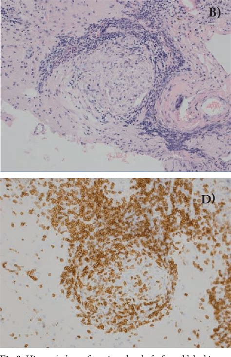 Figure From A Case Of Relapsing Isolated Neurosarcoidosis In An