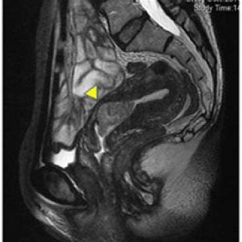 T2 Weighted Sagittal Mri Findings T2 Weighted Sagittal Mri Revealed