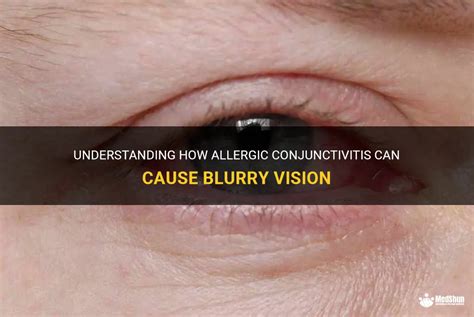 Understanding How Allergic Conjunctivitis Can Cause Blurry Vision Medshun