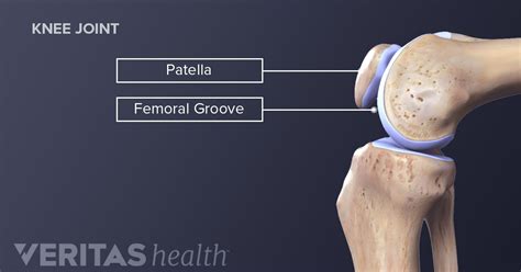 Patellofemoral Pain Syndrome Definition Sports Injury Related Medical