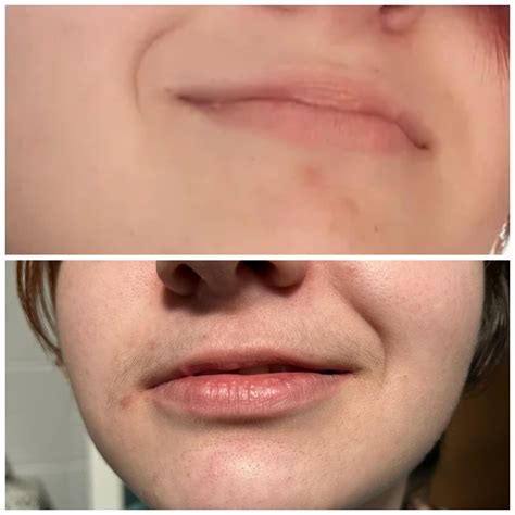 Mustache Comparison Before T Vs 3 Months R Transtimelines