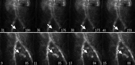 Normal Penile Uptake Of The Radiotracer At 99m Tc Labeled Rbc