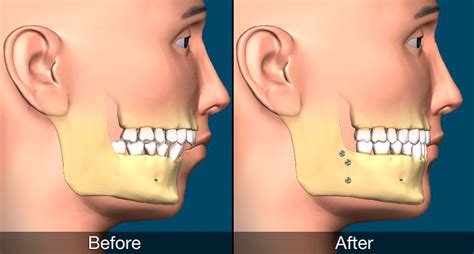 Orthognathic Corrective Jaw Surgery Genioplasty Chin Surgery