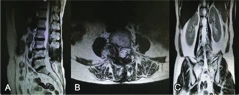 At 6 Months Postoperative Follow Up T2 Weighted Sagittal A Axial Download Scientific