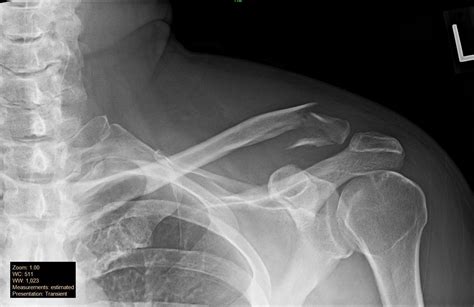 Broken clavicle, distal, surgery or no? : AskDocs