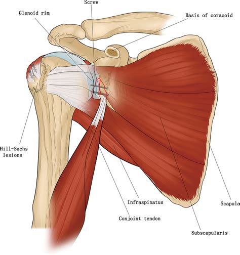 The No4 Patients Surgical Diagrams Showing Latarjet Procedure With