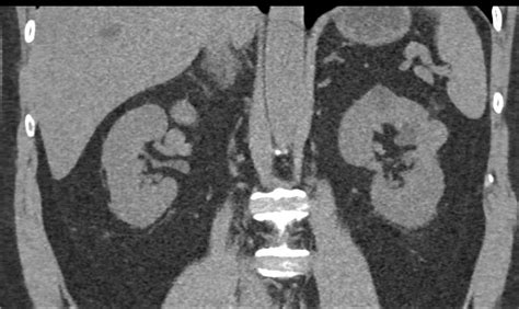 Post Cryoablation Changes Left Kidney - Kidney Case Studies - CTisus CT ...