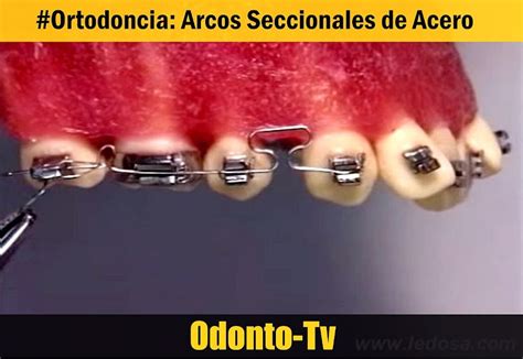 Ortodoncia Arcos Seccionales De Acero Odonto Tv