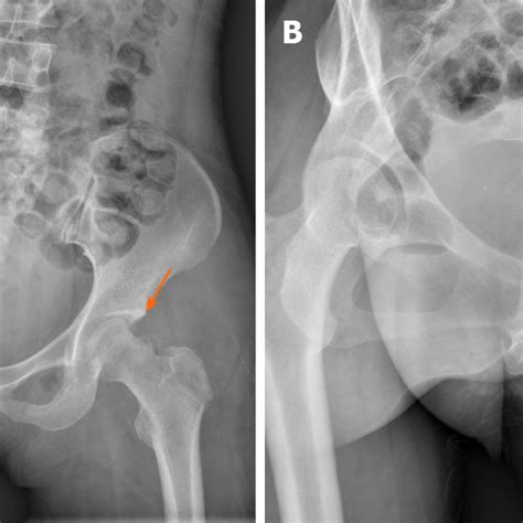 Postoperative Plain Radiographs A Anteroposterior Orange Arrow B Download Scientific