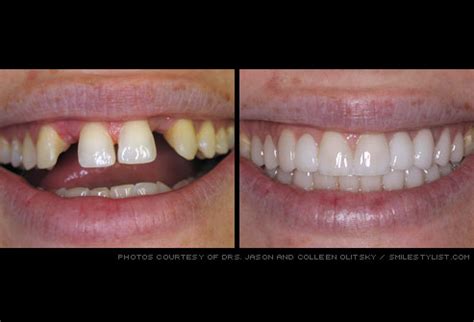 Cosmetic Dentistry Before And After - Dental News Network