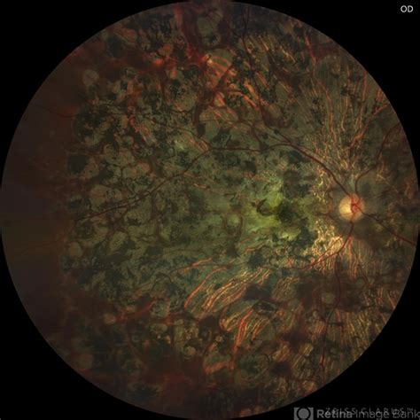 Cone-Rod Dystrophy - Retina Image Bank