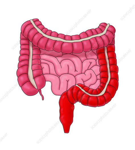 Ulcerative Colitis Typical Location Illustration Stock Image C0365926 Science Photo Library