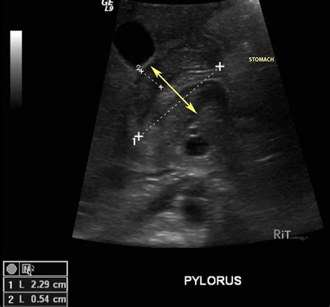 Pyloric Stenosis Ultrasound