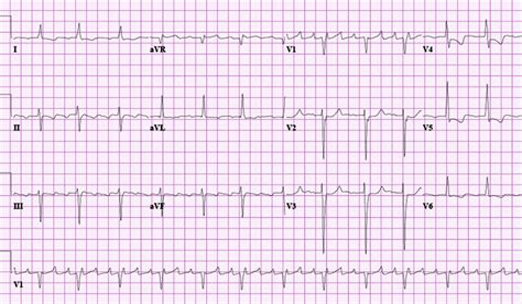 Atrial Flutter Causes