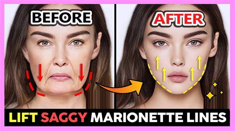 Facelift For Heavy Saggy Lower Face Massage Remove Marionette Lines