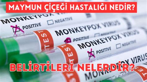 Maymun Çiçeği hastalığı nedir belirtileri nelerdir