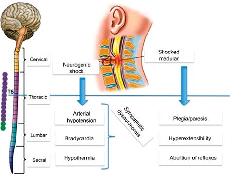 Neurogenic Shock - Homecare24