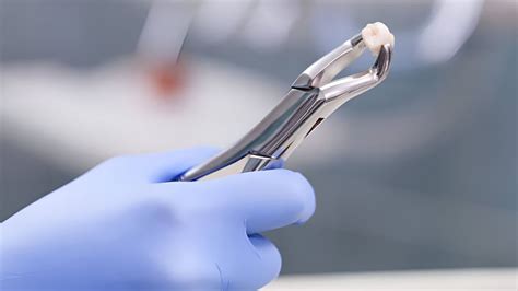 Após Extração De Dente - Como higienizar a boca após extração de dente? Veja 6 dicas!