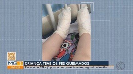 Criança que queimou os pés ao pisar em tampa superaquecida em creche