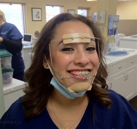 Braces Girlswithbraces Facemask Dental Braces Braces Tips Teeth