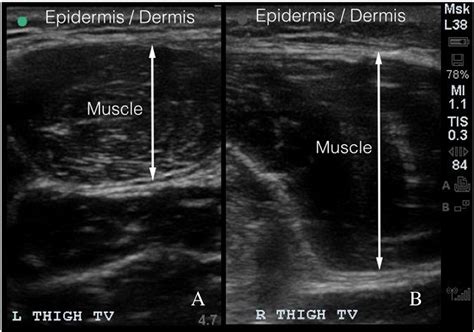 Figure 1 From Point Of Care Ultrasound Differentiates Pyomyositis From