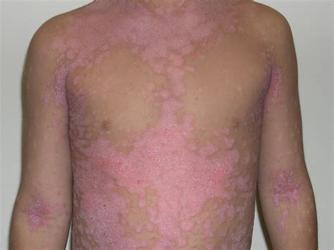 Psoriatic Arthritis Rash Images Symptoms And Treatment Goodrx