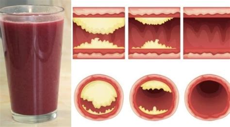 Only A Glass Of This Juice Will Help You Unclog Arteries