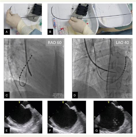 Figure From Transseptal Puncture And Catheter Ablation Via The