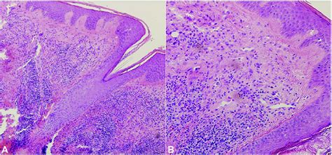 Hematoxylin And Eosin Stain Of Left Postauricular Skin Biopsy