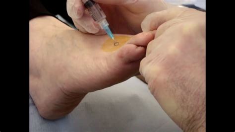 Injection Csi Technique For Stump Mortons Neuroma Youtube