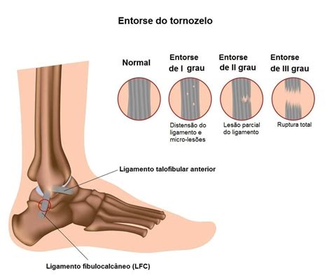 Entorse do tornozelo sintomas tratamento exercícios e reabilitação