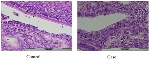 Microscopic View Of Fallopian Tube Epithelium In Case Vs Control Group