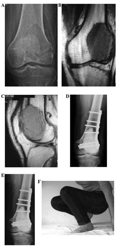 Tumor On Femur Bone Adult