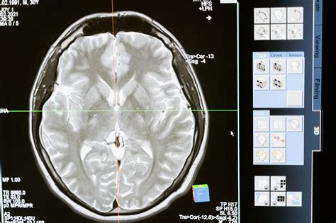 Lesión Cerebral Traumática Tbi Causas Síntomas Y Acciones Legales