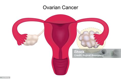 Ovarian Cancer Uterus Anatomy Female Reproductive System Vector Stock Illustration Download