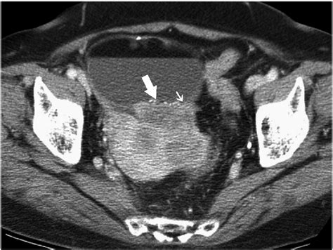 CT Findings Of Mature Cystic Teratoma With Malignant Transformation