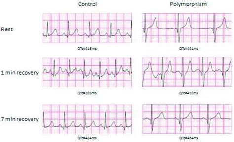 Comparison Of Ecg Tracings Between Example Control And Snp Patients At