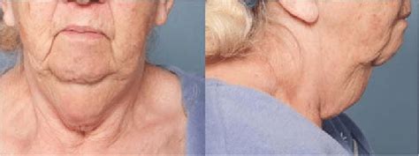 Elderly Woman With A Large Turkey Gobbler Skin Tag Of The Neck