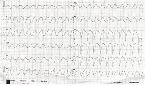 Last ECG showing ventricular tachycardia | Download Scientific Diagram