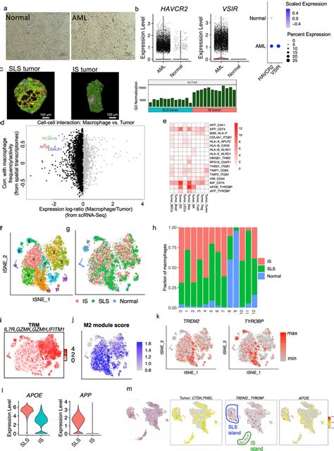 The Suppressive Immune Environment Is Shaped By Tumor Cell States A