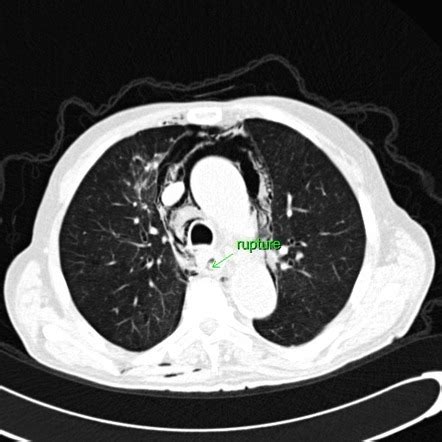 Iatrogenic Esophageal Perforation Radiology Case Radiopaedia Org