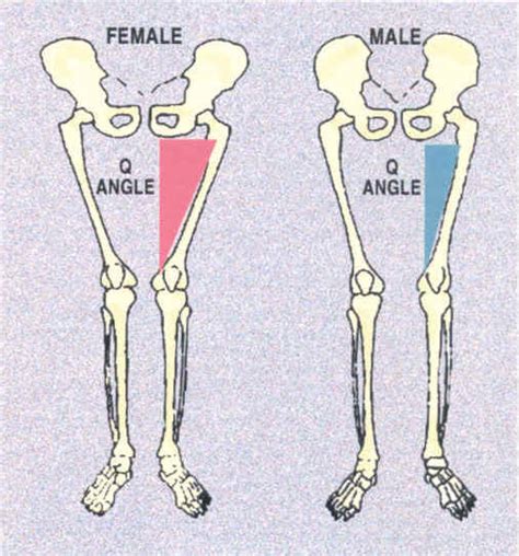 Knee Valgus (Valgus Collapse), Glute Medius Strengthening, Band Hip Abduction Exercises, and ...