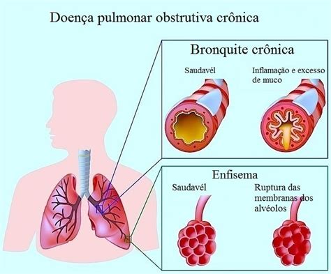 Sintomas Da Bronquite Aguda Ou Cr Nica Tratamento E Rem Dios Naturais