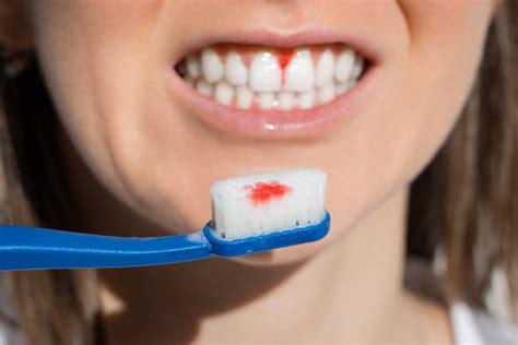 Sangrado De Encías Causas Y Soluciones Gaceta Dental