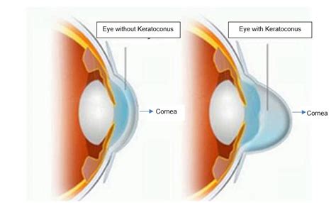 Keratoconus What Is It Causes And Treatment