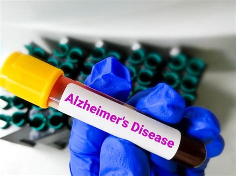 Premium Photo Blood Testing For Diagnosis Alzheimer S Disease